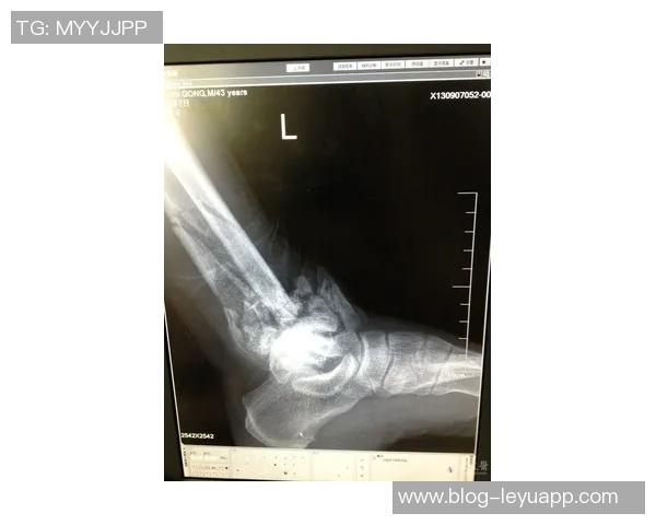 广西平果队员黄威右侧胫腓骨骨皮质断裂预计恢复时间为八个月